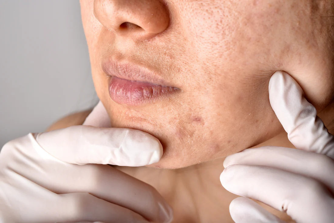 The Key to Healthy Skin: Understanding Your Skin Barrier